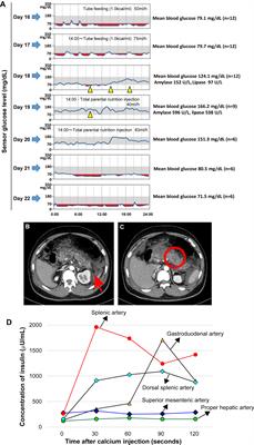 Case Report: A Difficult-to-Diagnose Case of Hyperinsulinemic Hypoglycemia Surgically Treated After Developing Acute Pancreatitis